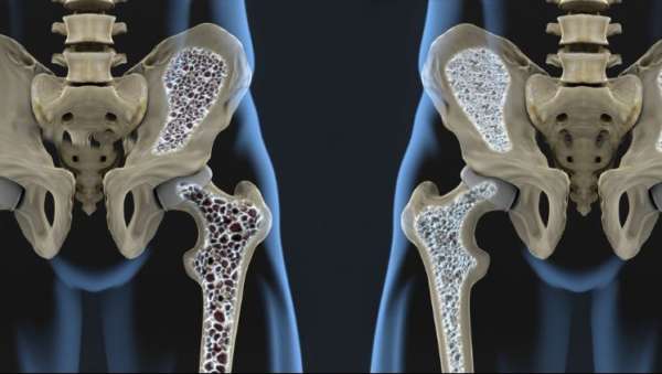 pathological fracture due to osteoporosis icd 10